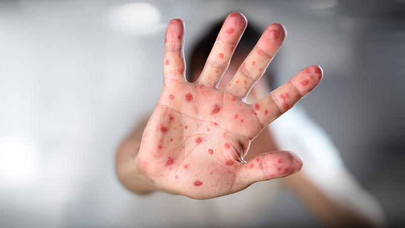 Veszélyes fertőzés gyanúja miatt tilos a látogatás a szombathelyi infektológián